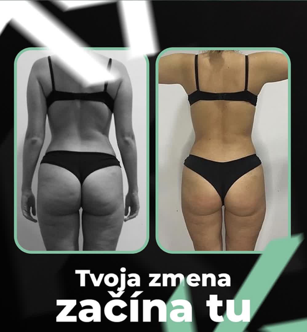 Tvoja zmena začína tu. Skutočný výsledok klientky ukazuje, že zmena je dosiahnuteľná.